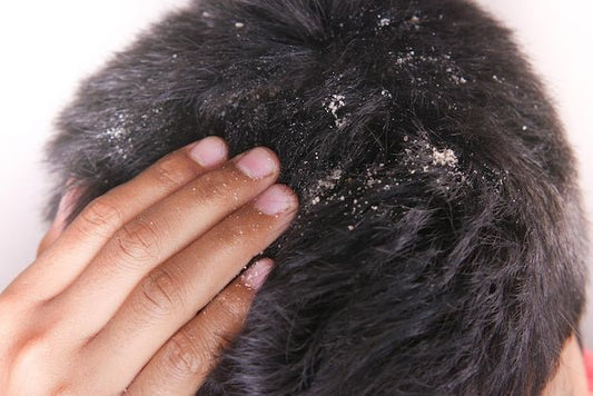 How to Cure Dandruff Permanently: Best Treatments, Remedies & Tips
