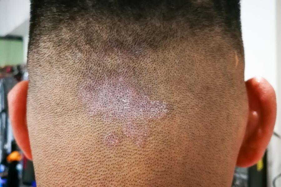ringworm in humans on head