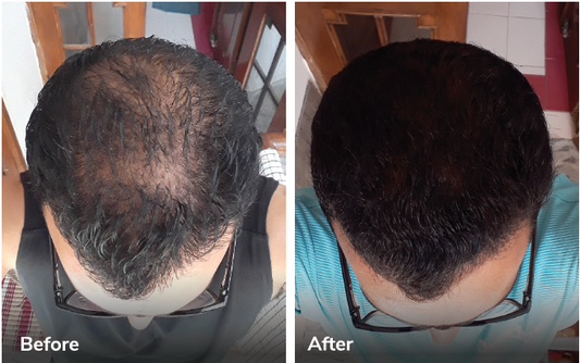 Honest Traya Hair Review : What Real Users Are Saying After 6 Months