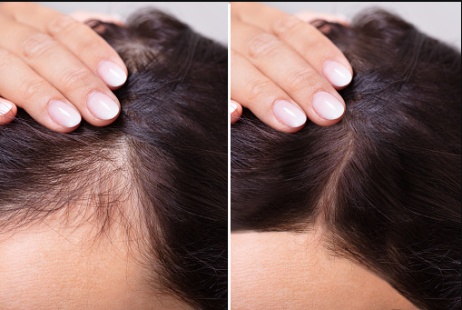 Hair Loss Treatment in India | Holistic & Proven Solutions