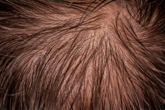 Androgenetic Alopecia: It's Not Just Men, Women Face It Too