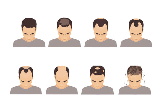 How To Avoid A Receding Hairline For Men: 7 Hair Loss Prevention Tips