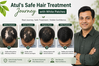 Atul's Safe Hair Treatment Journey with White Patches