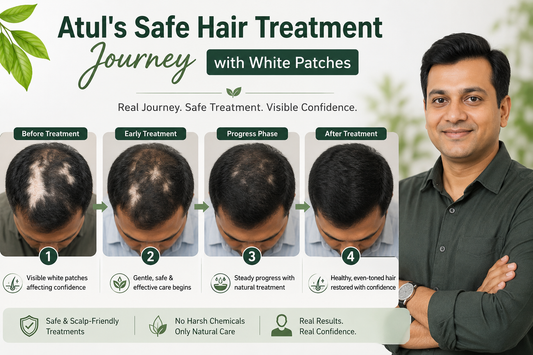 Atul's Safe Hair Treatment Journey with White Patches