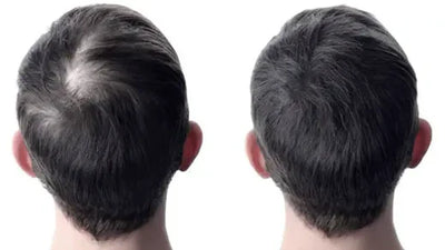 Traya Hair Regrowth Kit: Does It Really Work?