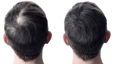 How to Stop Hair Fall Immediately? 12 Best Easy Home Remedies