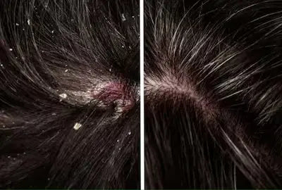 1 दिन में डैंड्रफ कैसे हटाएं? असरदार घरेलू उपाय जानें