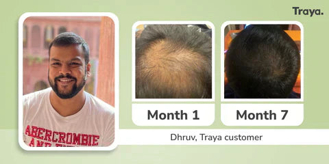 Traya Hair Results