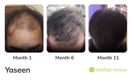 Minoxidil Before and After