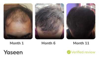 Minoxidil Results - Before and After | Results, Safety & Traya Plan