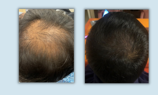 Dhruv’s Hair Growth Journey With Traya