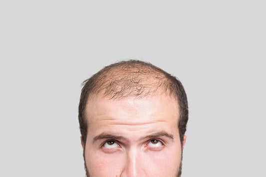 Male pattern baldness, causes and treatment