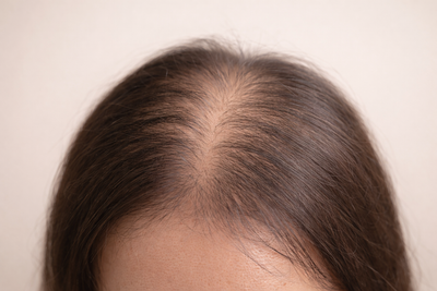 Prolactin Imbalance & Hair Fall: Causes & Treatment