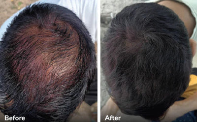 Does Traya Really Work on Hair Fall or Baldness?