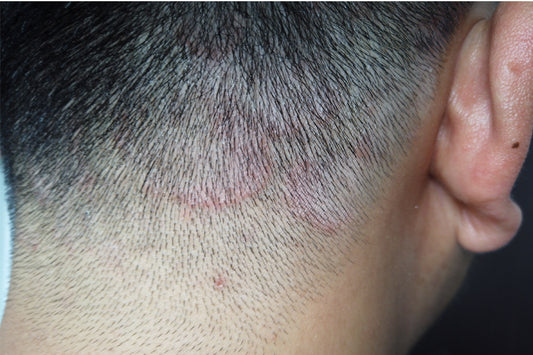ringworm on scalp, causes, treatment