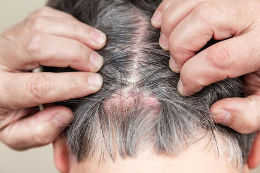 What Is The Leading Cause Of Scalp Folliculitis And How Should We Treat It?