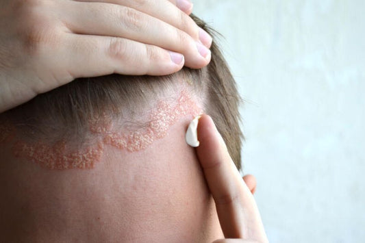 What Is Seborrheic Dermatitis - Cause, Symptoms, Treatment And Cure