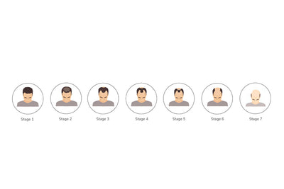 What are the Different Stages of Hair Loss According to The Norwood Scale?