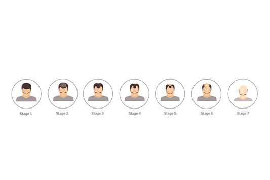 What is a Norwood Scale and Stages of hair loss?