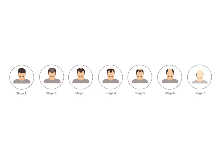 What is a Norwood Scale and Stages of hair loss?