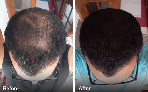 What to expect on your Traya hair fall Customized Plan journey each month?