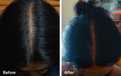 What Causes Postpartum Hair Loss and How to Manage It