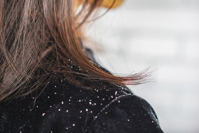 डैंड्रफ के कारण, लक्षण और उपचार | Dandruff in Hindi - संपूर्ण गाइड