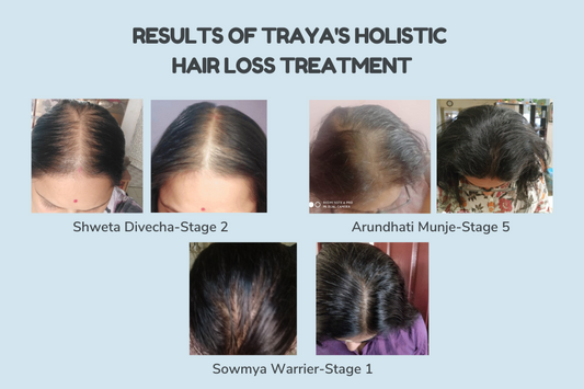 A Case Study of Female Pattern Hair Loss Improved in Women by Traya’s Holistic Treatment