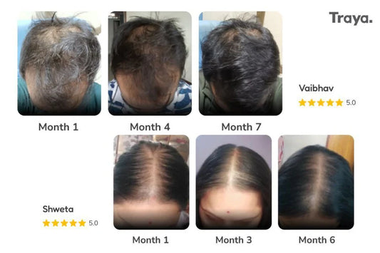 Real Success Stories: Hair Regrowth Naturally with Traya’s Approach