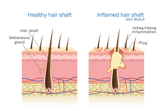 Oily (Greasy) Hair: Causes, Treatment, & Home Remedies