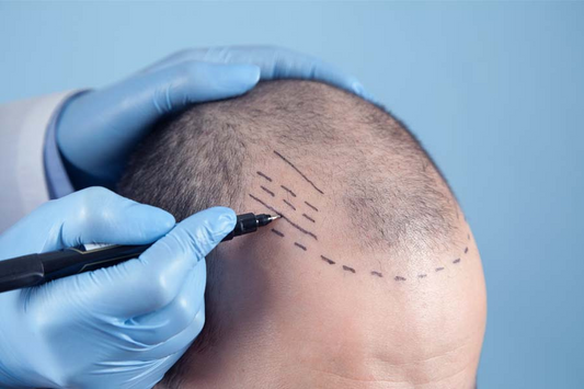 Why you need minoxidil after your Hair Transplant