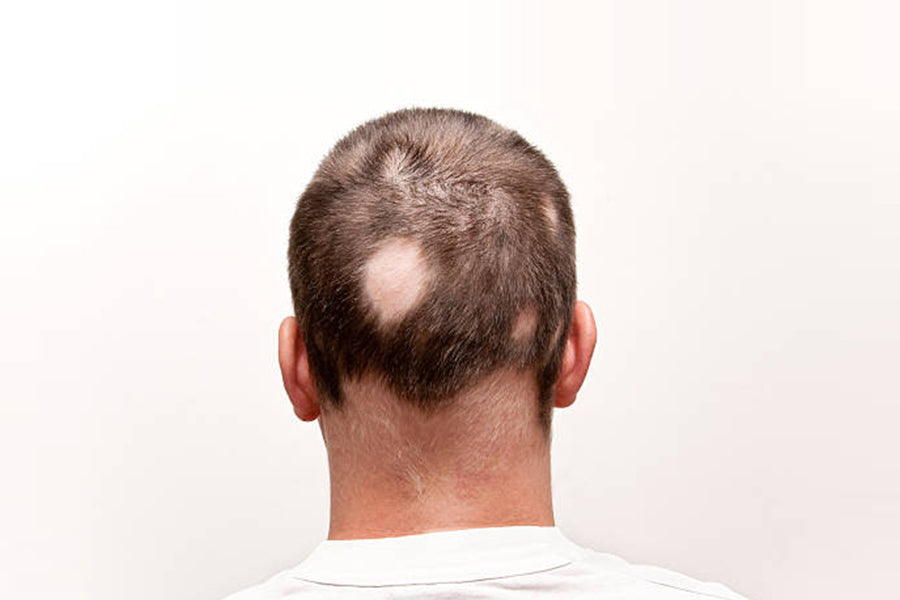 Hair Loss - DrWeil.com