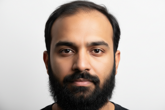 Beard Growth vs Scalp Hair Loss