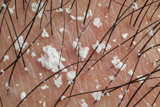 डैंड्रफ (Dandruff): स्कैल्प की परतें झड़ने की समस्या