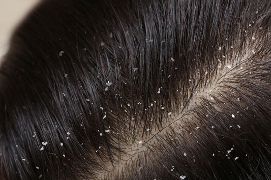 What Are The Main Causes Of Dandruff