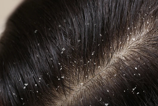 How To Remove Dandruff in Just One Wash Amazing DIY Remedies