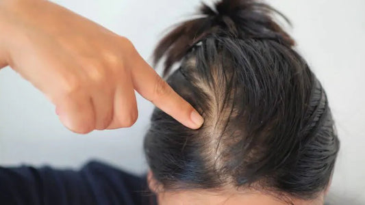 Causes of Hair Loss in Women and How to Treat It from the Root