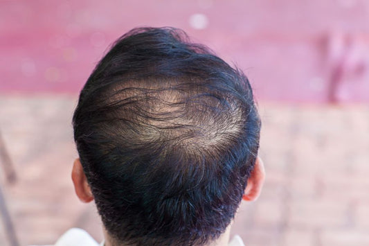Hair Thinning In Males And How To Fight It