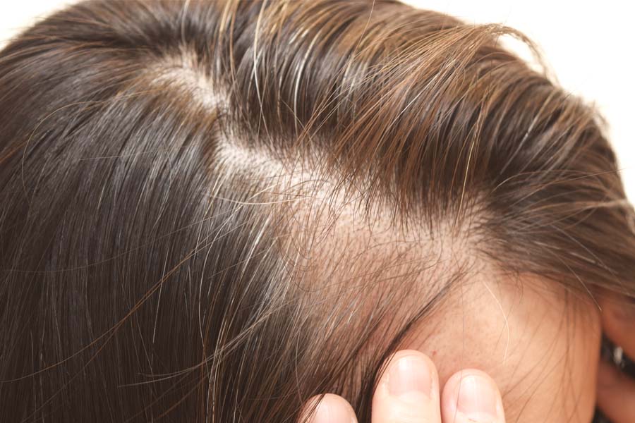 What are the reasons for hair thinning in women? – Traya