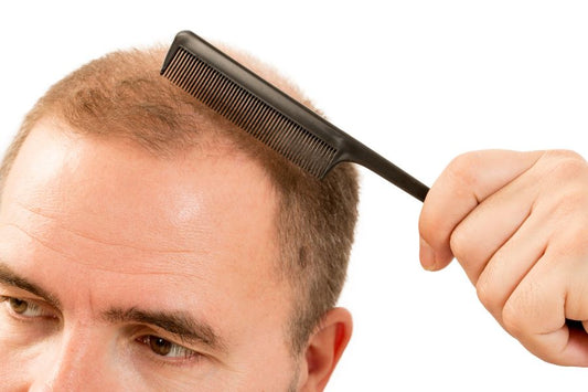 What Is The Reason Of Front Hair Thinning In Male