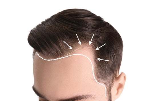 Receding Hairline