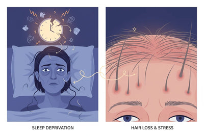 Impact of Sleep Deprivation on Stress Hair Loss