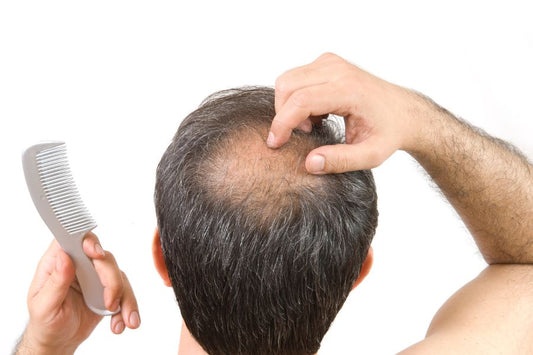 Telogen Effluvium VS Male Pattern Baldness