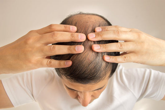 Can dieting cause hair loss?