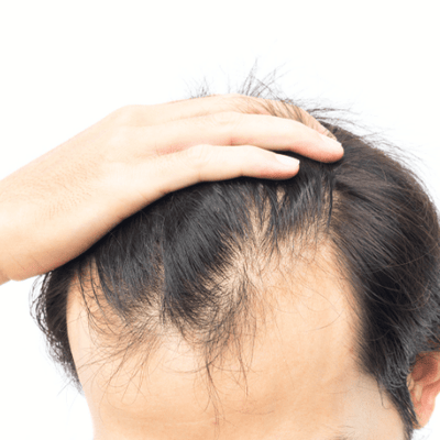 How to Stop Receding Hairline? 4 Best Treatments You Can Try