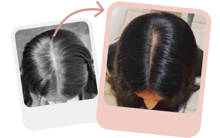 A Case Study of Female Pattern Hair Fall Improved in Women by Traya’s Holistic Customized Plan