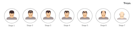 Hair Fall Risk Test: Find Out How Severe Your Hair Loss Is!