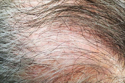 Traction Alopecia: Early Signs, Causes, And Treatment