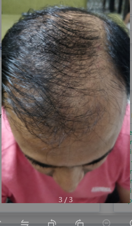 hair growth journey quora