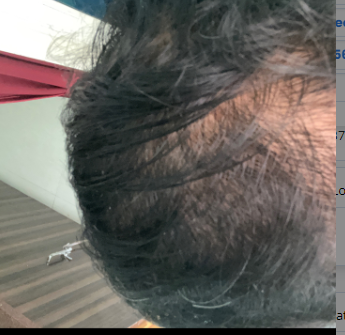 hair growth journey quora